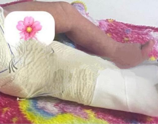 Família denuncia fratura em bebê durante parto e cobra respostas de hospital em Floriano