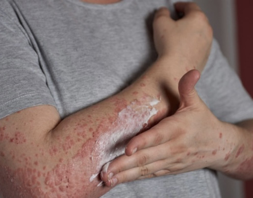 Alta taxa de hanseníase coloca o Piauí entre os estados mais afetados do país