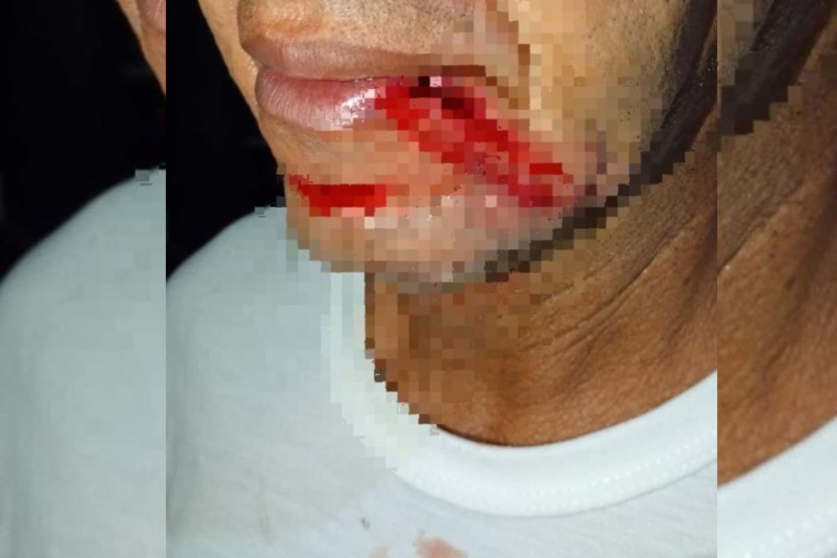 Padeiro fica ferido após fio de telefone enrolar em seu pescoço na zona Norte de Teresina