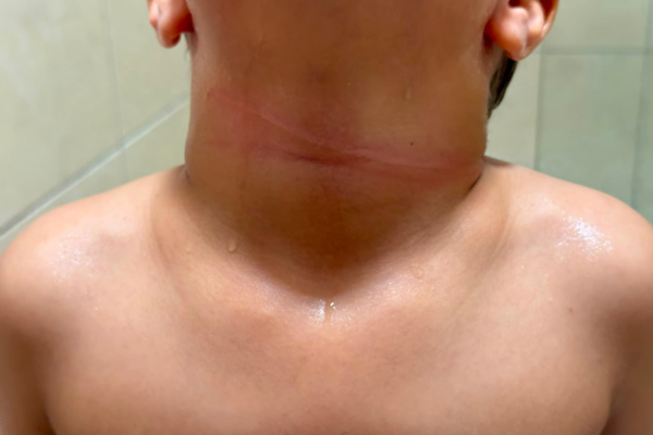 Criança fica ferida por linha com cerol em Parnaíba
