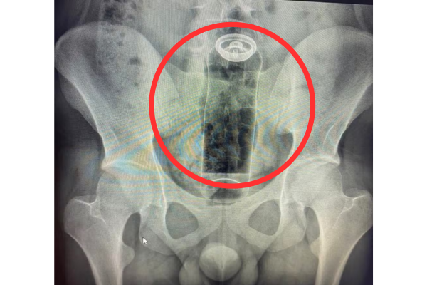 Jovem é internado após ficar com desodorante preso no reto; médico faz alerta