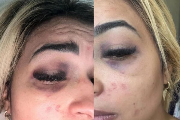 Empresária de Barras denuncia agressões cometidas pelo ex-companheiro