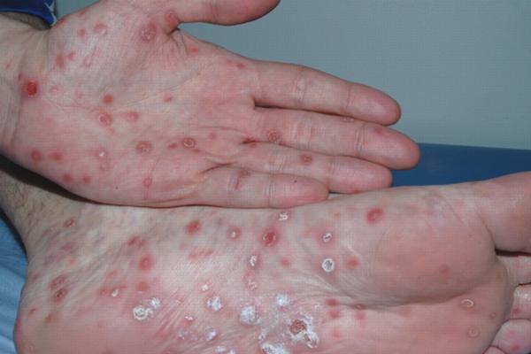 Mais de 5 mil casos de sífilis são registrados entre jovens no Piauí