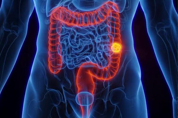 SUS passa a oferecer exame gratuito para detectar câncer intestinal
