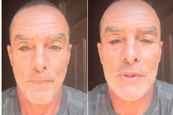 Situação inesperada causa derrame ocular no modelo e ator Paulo Zulu